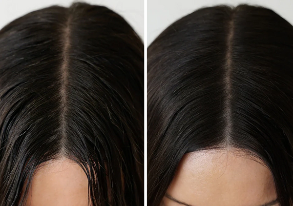 Why Is My Hair Greasy? The Science of Oily Scalp and How to Break the Cycle